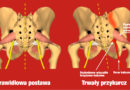 Rwa kulszowa gruszkowata – o głębokiej przyczynie i trwałym wyleczeniu
