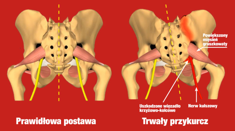 Rwa kulszowa gruszkowata – o głębokiej przyczynie i trwałym wyleczeniu